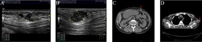 Subcutaneous soft tissue metastases from esophageal squamous cell carcinoma with neuroendocrine differentiation: Case report and literature review